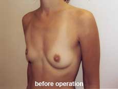 plastic-surgery-breast-augmentation 